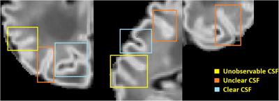 Robust Cortical Thickness Morphometry of Neonatal Brain and Systematic Evaluation Using Multi-Site MRI Datasets